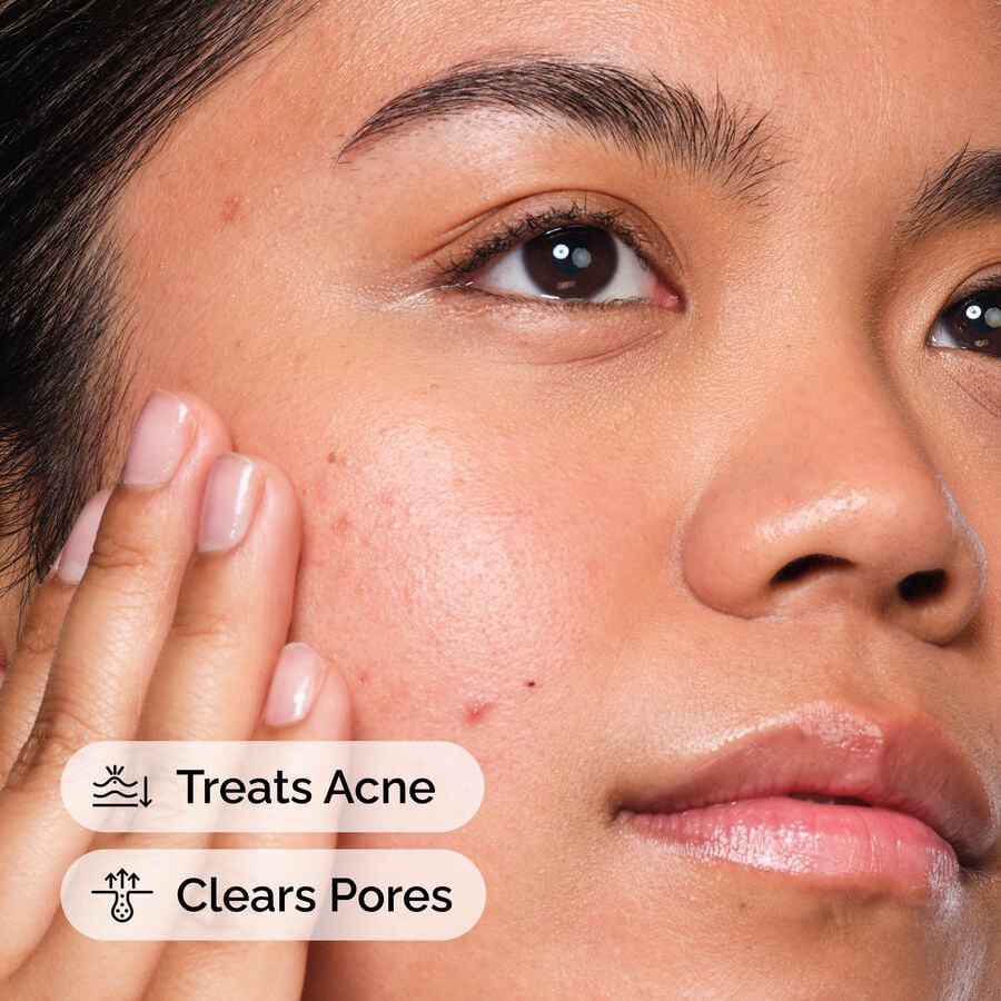 2% Salicylic Acid Solution for Blemish-Prone Skin