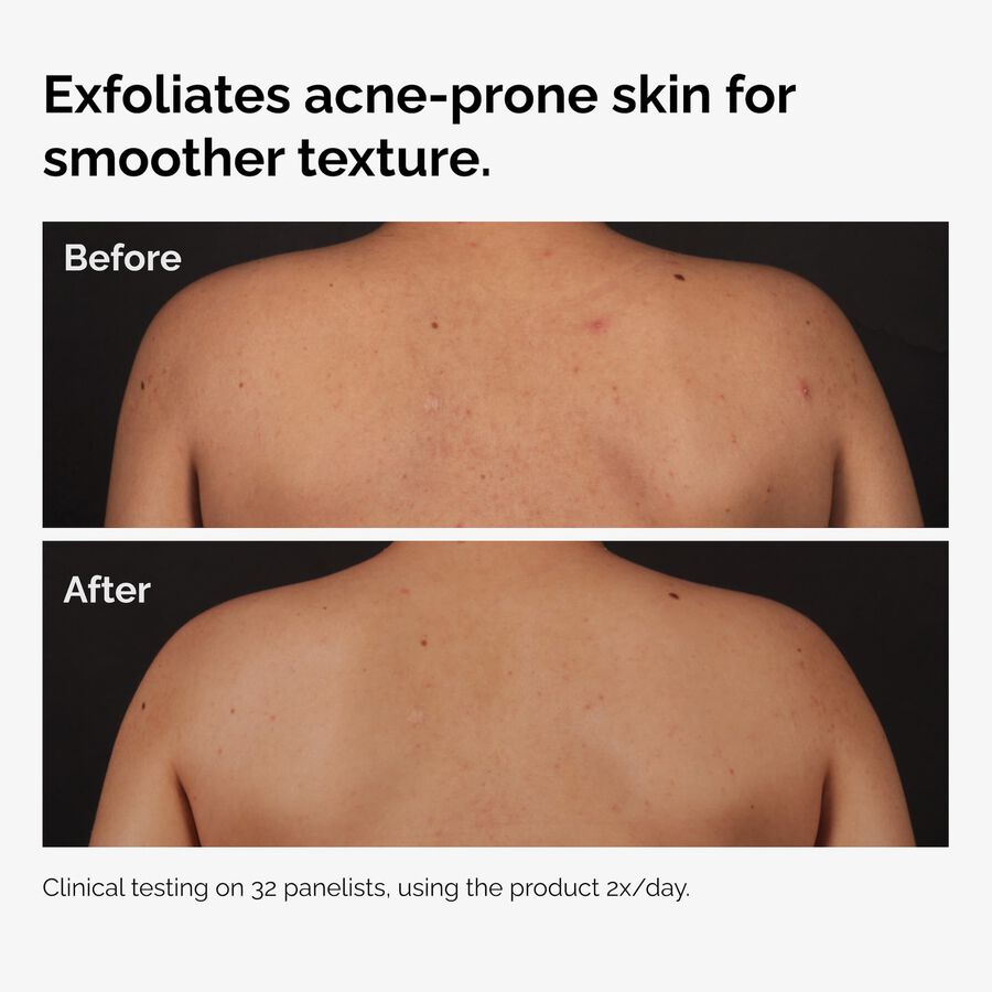 0.5% Salicylic Acid Exfoliating Body Serum