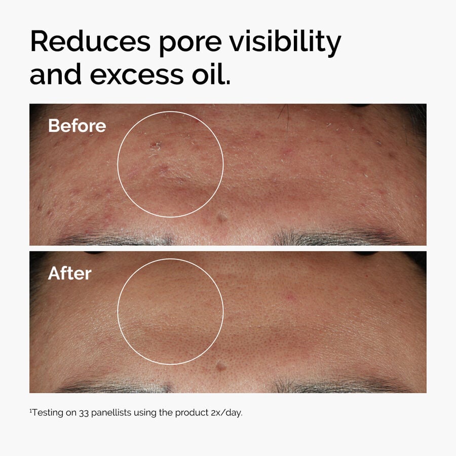 10% Niacinamide + 1% Zinc Clarifying Serum