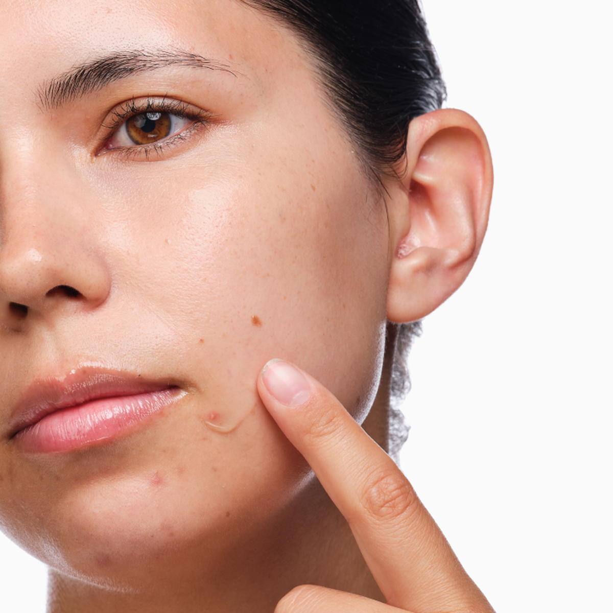 3-Step Acne Care Set
