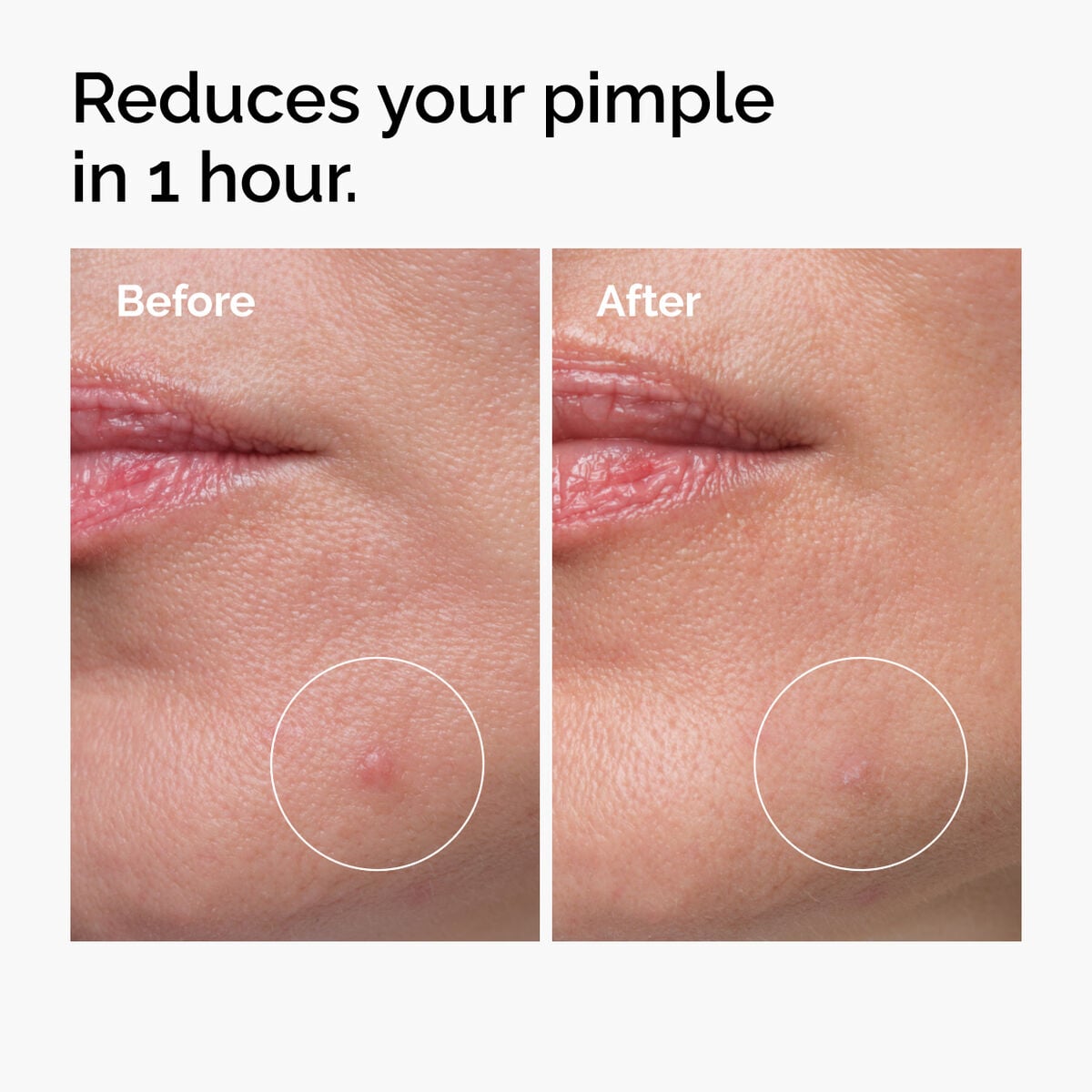 Powder-to-Cream Sulfur Concentrate for Pimples